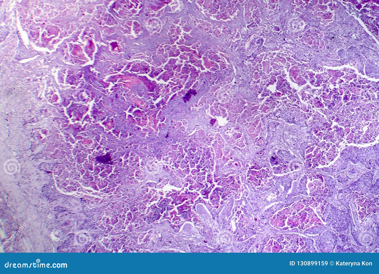 Squamous Cell Carcinoma Of The Lung Stock Image Image of