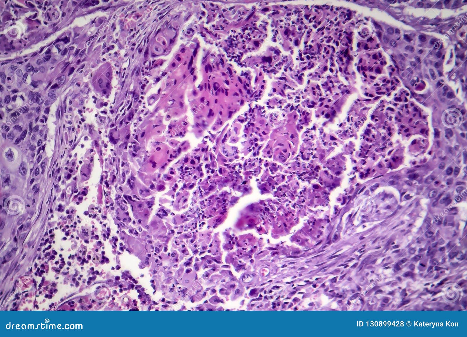 Squamous Cell Carcinoma Of The Lung Stock Photo Image of
