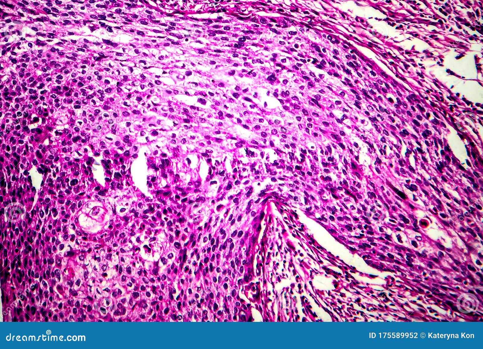Squamous Cell Carcinoma of the Uterus, Light Micrograph Stock Photo