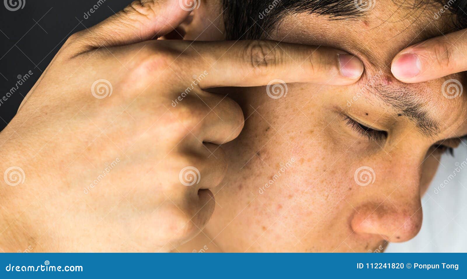 Squeeze Acne, Men Suffer from Pimples Stock Photo Image of white