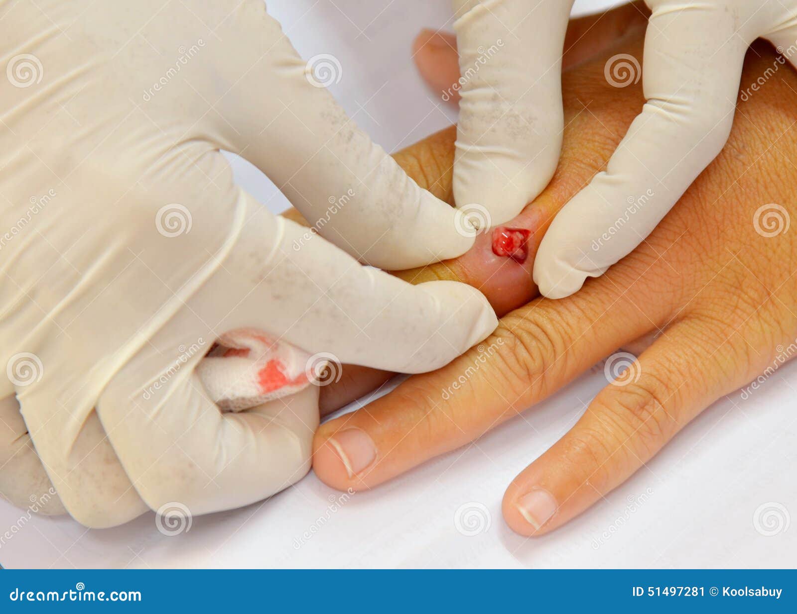 Squeezing abscess wound stock image. Image of fingers 51497281