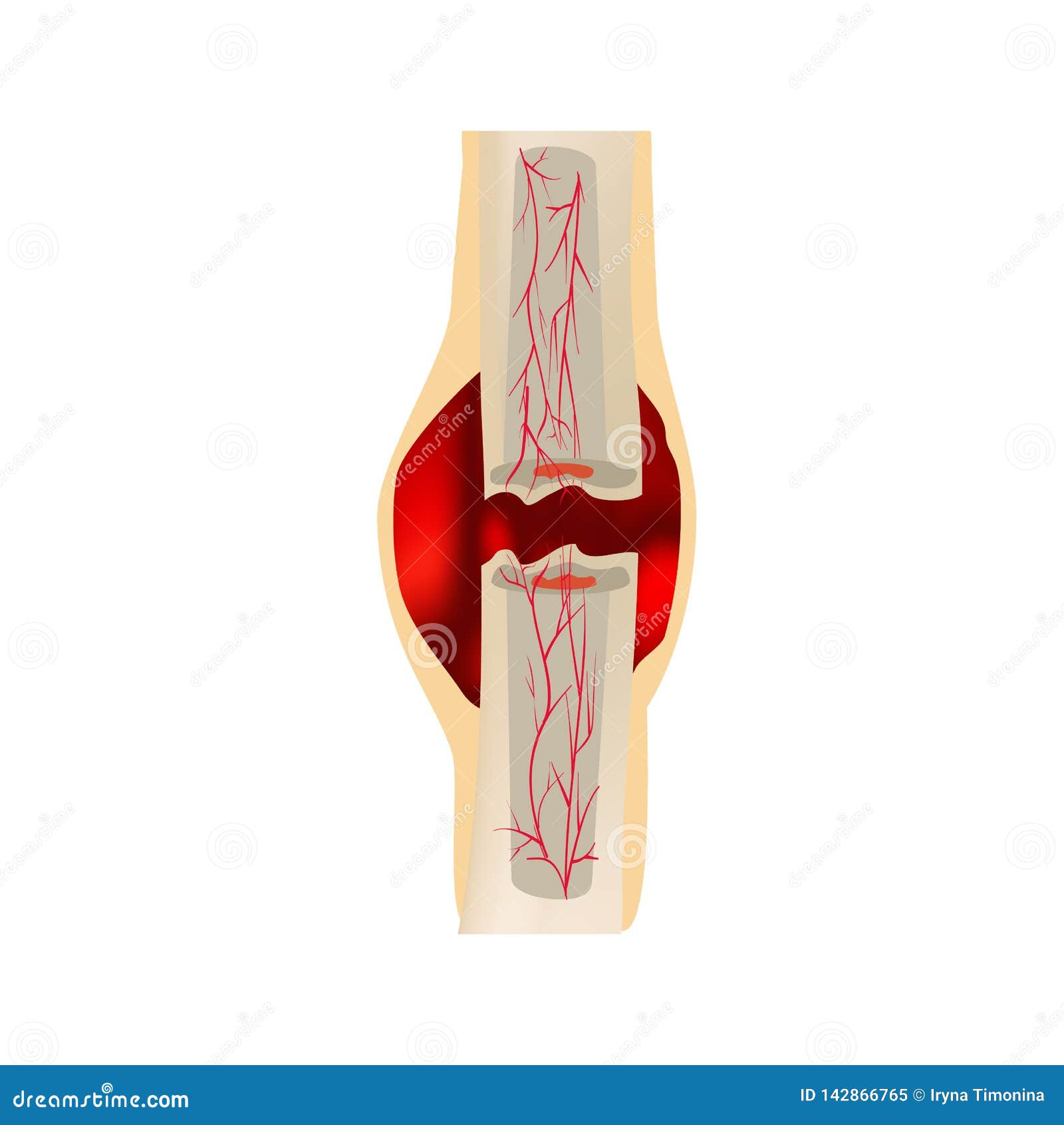 1 stage of healing bone fracture. formation of callus. hematoma. the bone fracture. infographics.   on