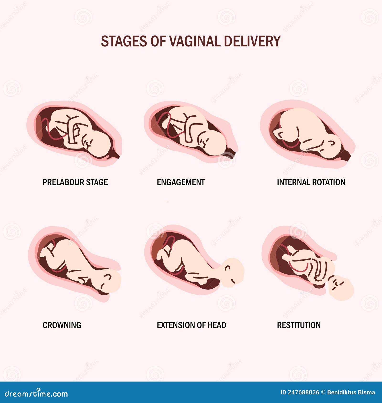 Vaginal Delivery Stock Illustrations – 79 Vaginal Delivery Stock Illustrations, Vectors & Clipart - Dreamstime Vaginal Delivery Stock Illustrations – 79 Vaginal Delivery Stock Illustrations, Vectors & Clipart - Dreamstime