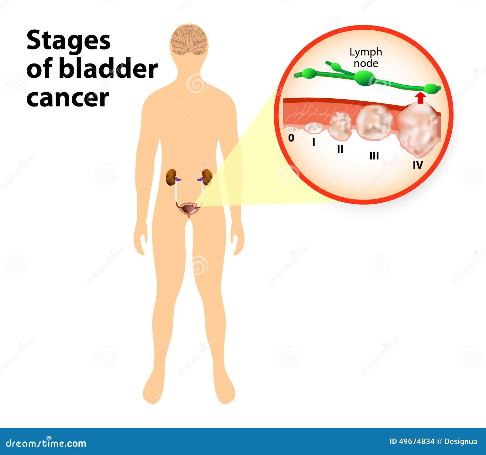 bladder cancer bladder cancer