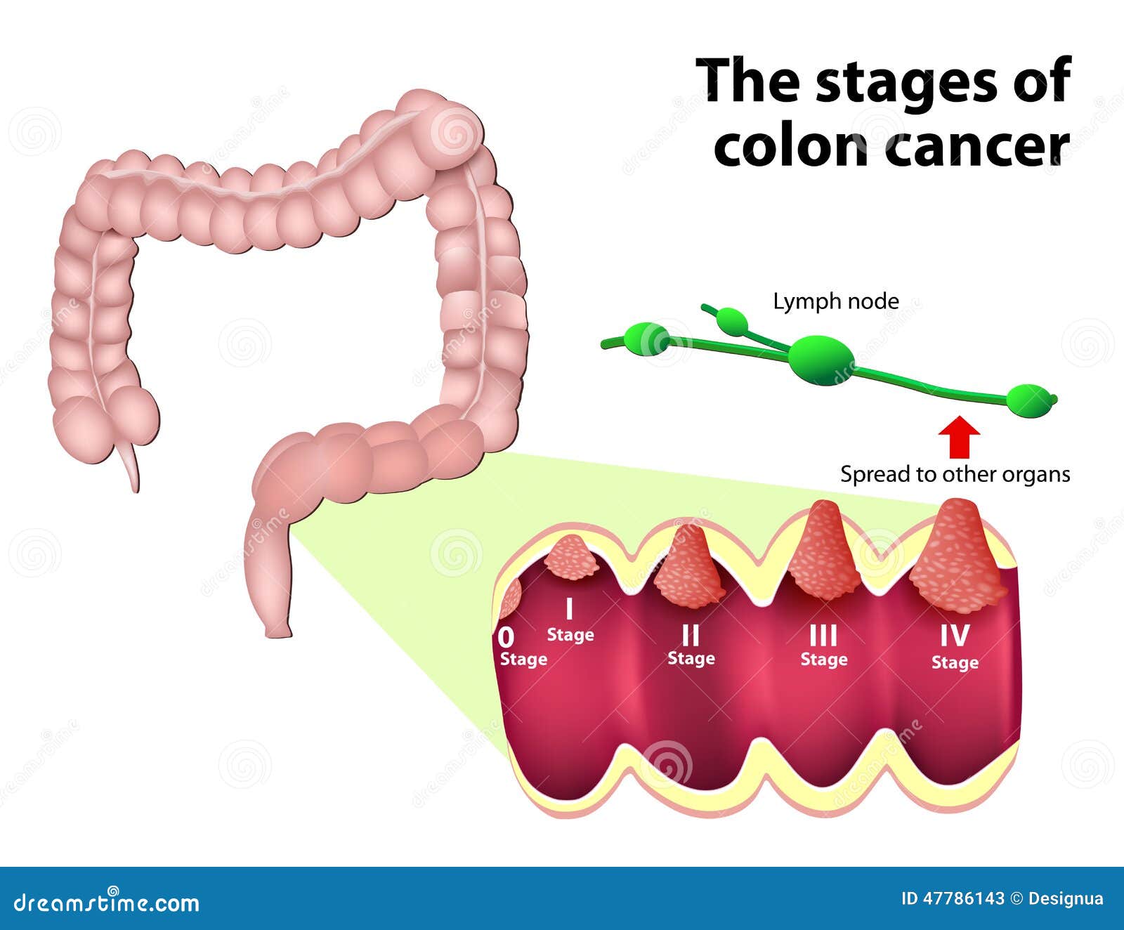 colon cancer stage 0