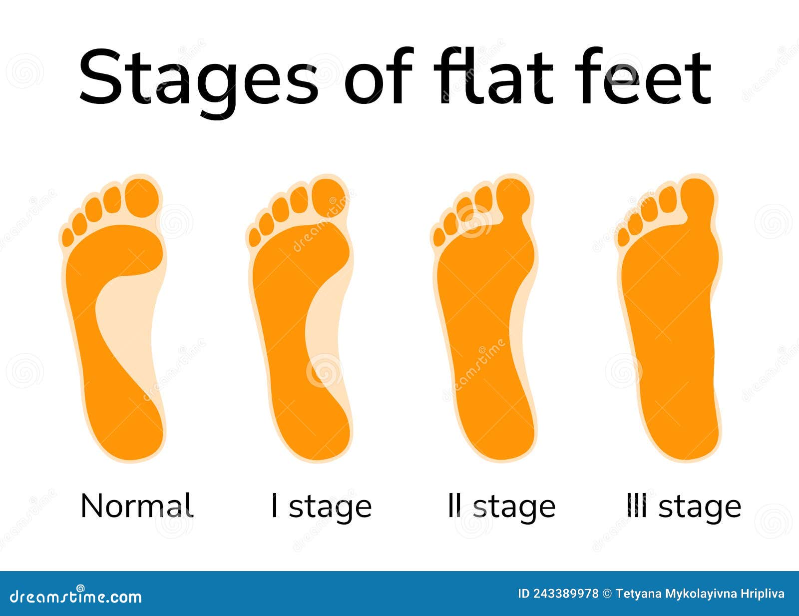 Stages of flat feet stock vector. Illustration of human 243389978