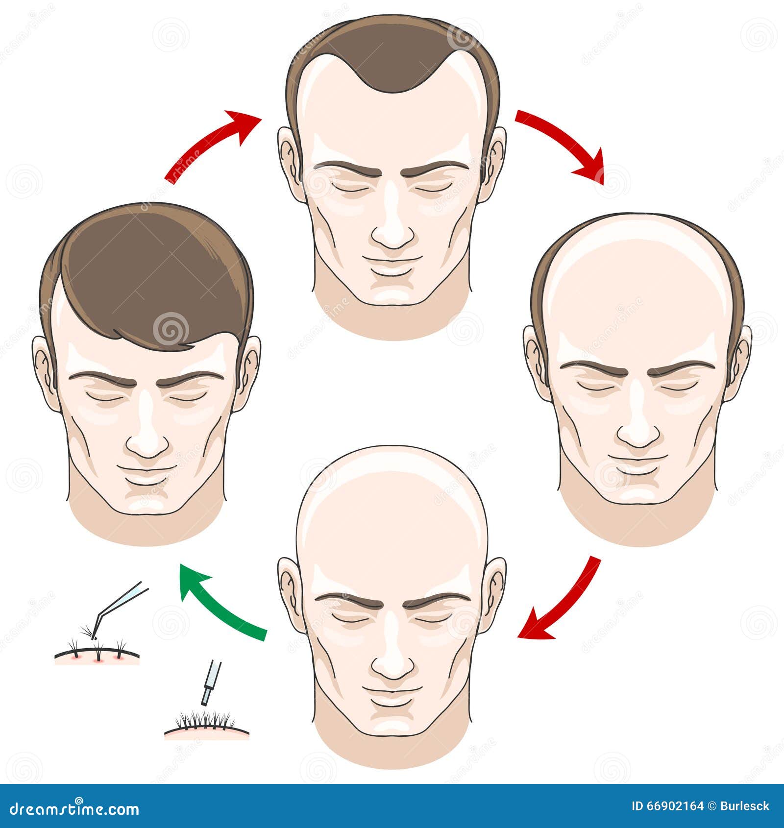 stages of hair loss, treatment and transplantation