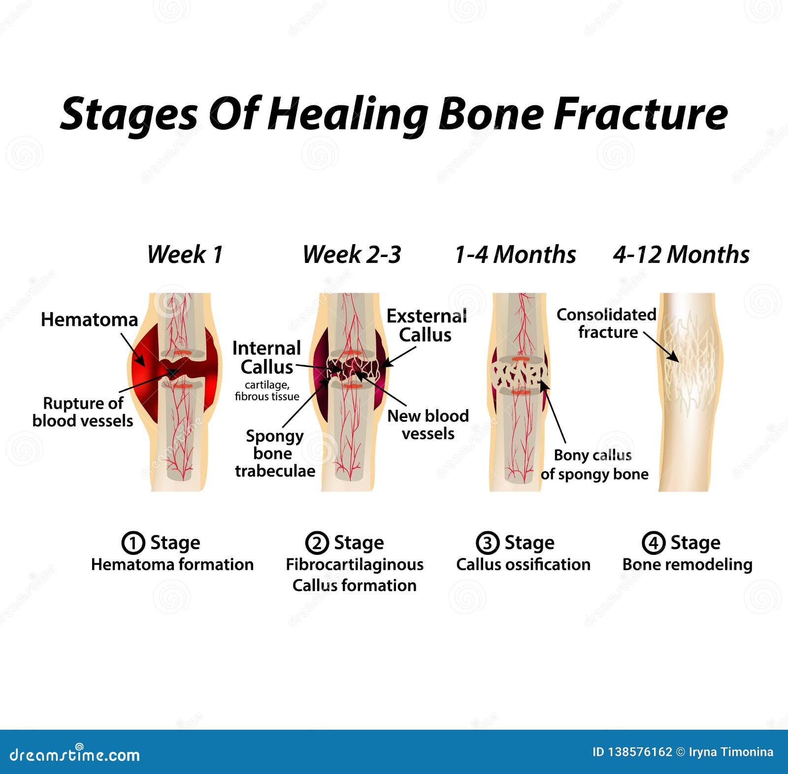 stages of healing bone fracture. formation of callus. the bone fracture. infographics.   on 