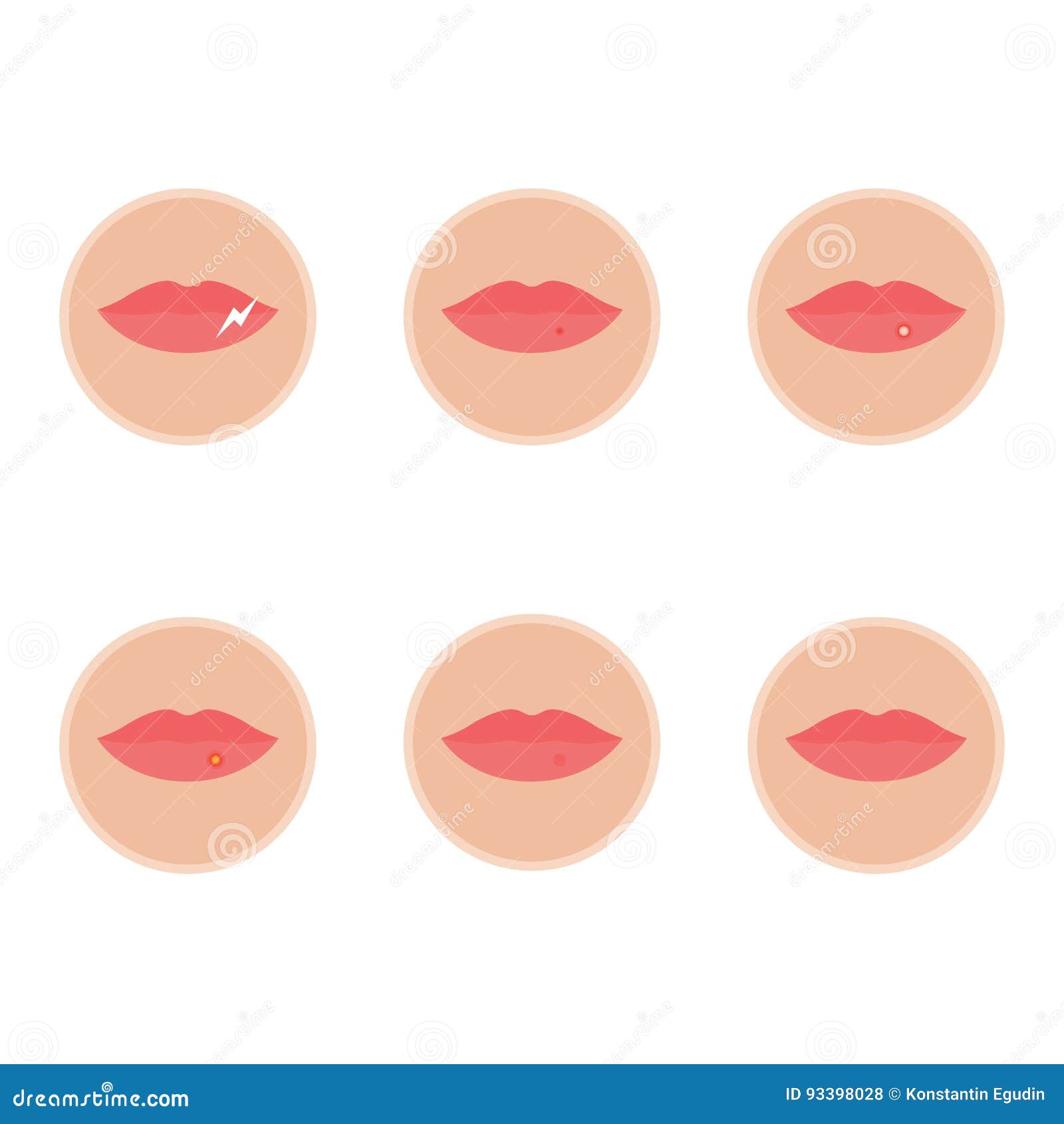 Stages of herpes stock vector. Illustration of face, macro 93398028