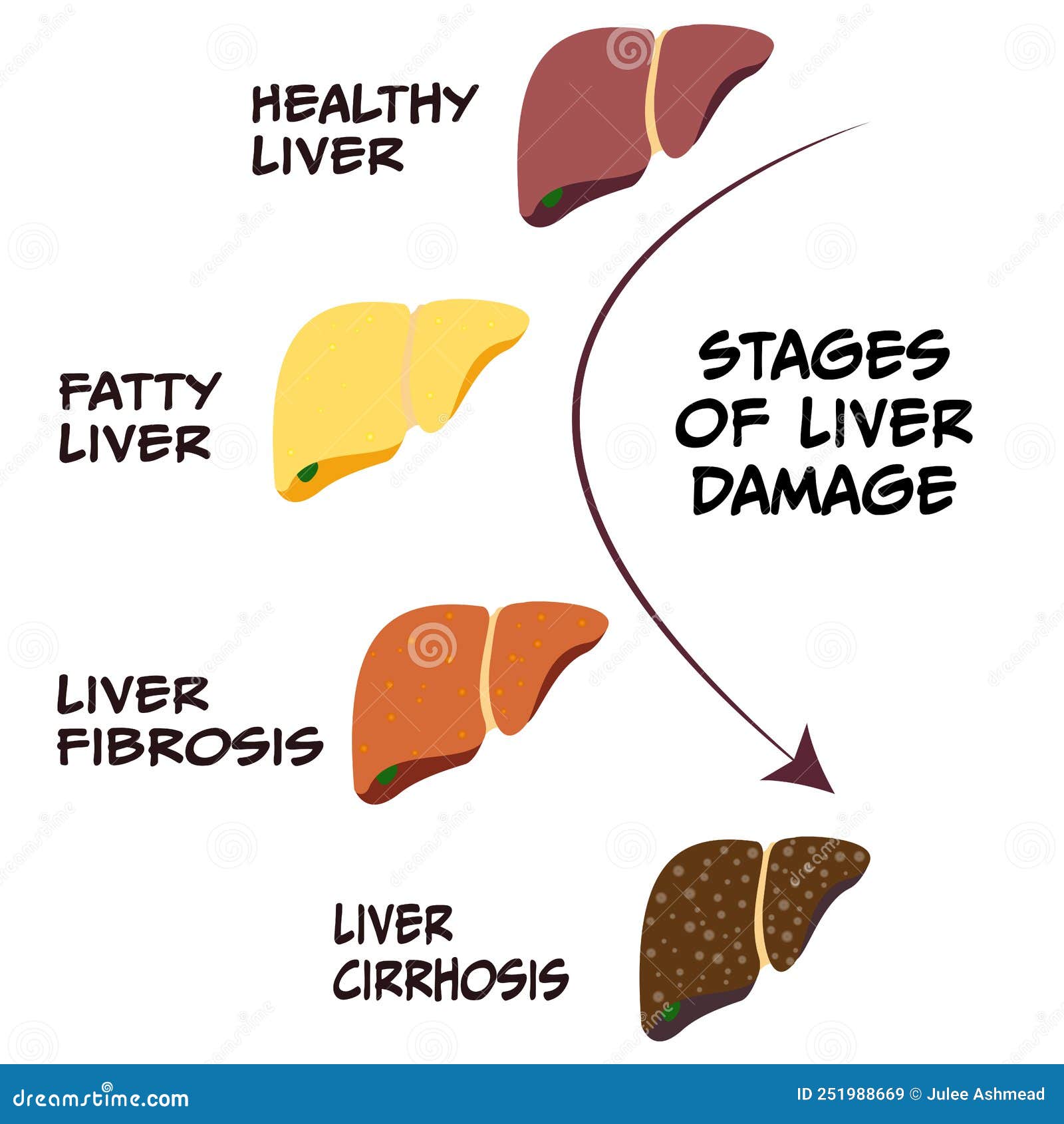 Stages of Liver Damage and Disease Stock Vector - Illustration of ...