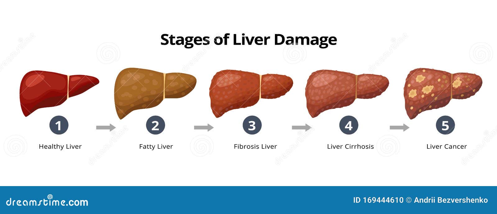 Liver Cirrhosis Stages