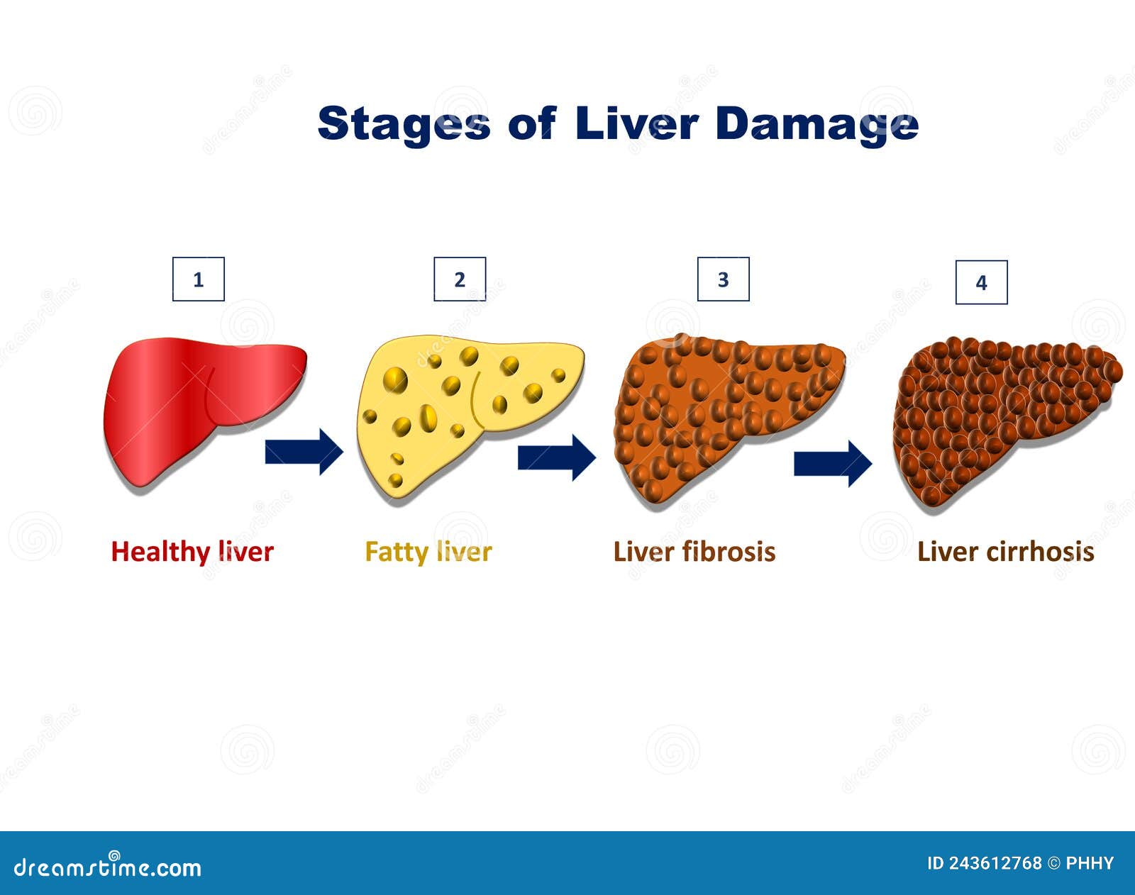 Stages of Liver Damage, Liver Injury Fatty Liver, Liver Fibrosis, Liver ...