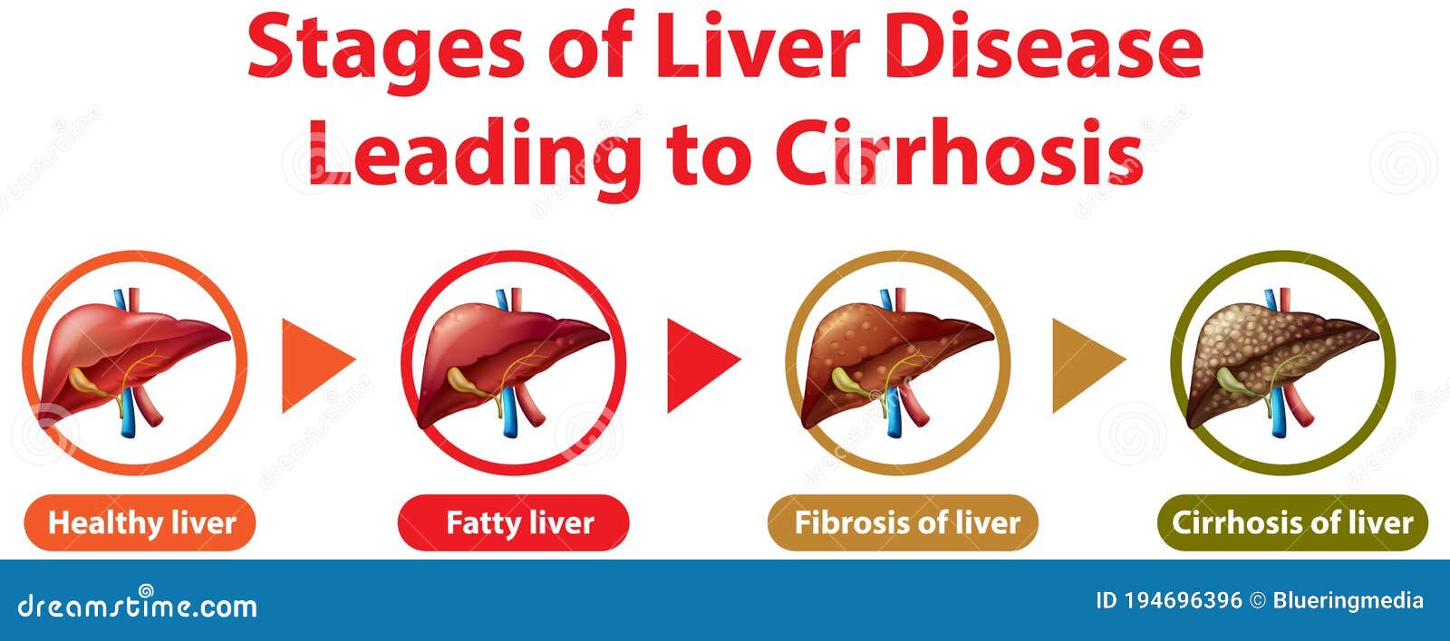 Stages Of Liver Disease Leading To Cirrhosis Stock Vector