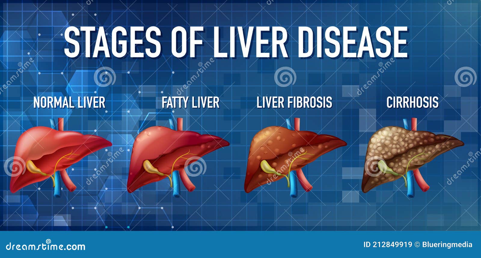 Stages Of Liver Damage. The First Symptoms Of Liver Problems Are