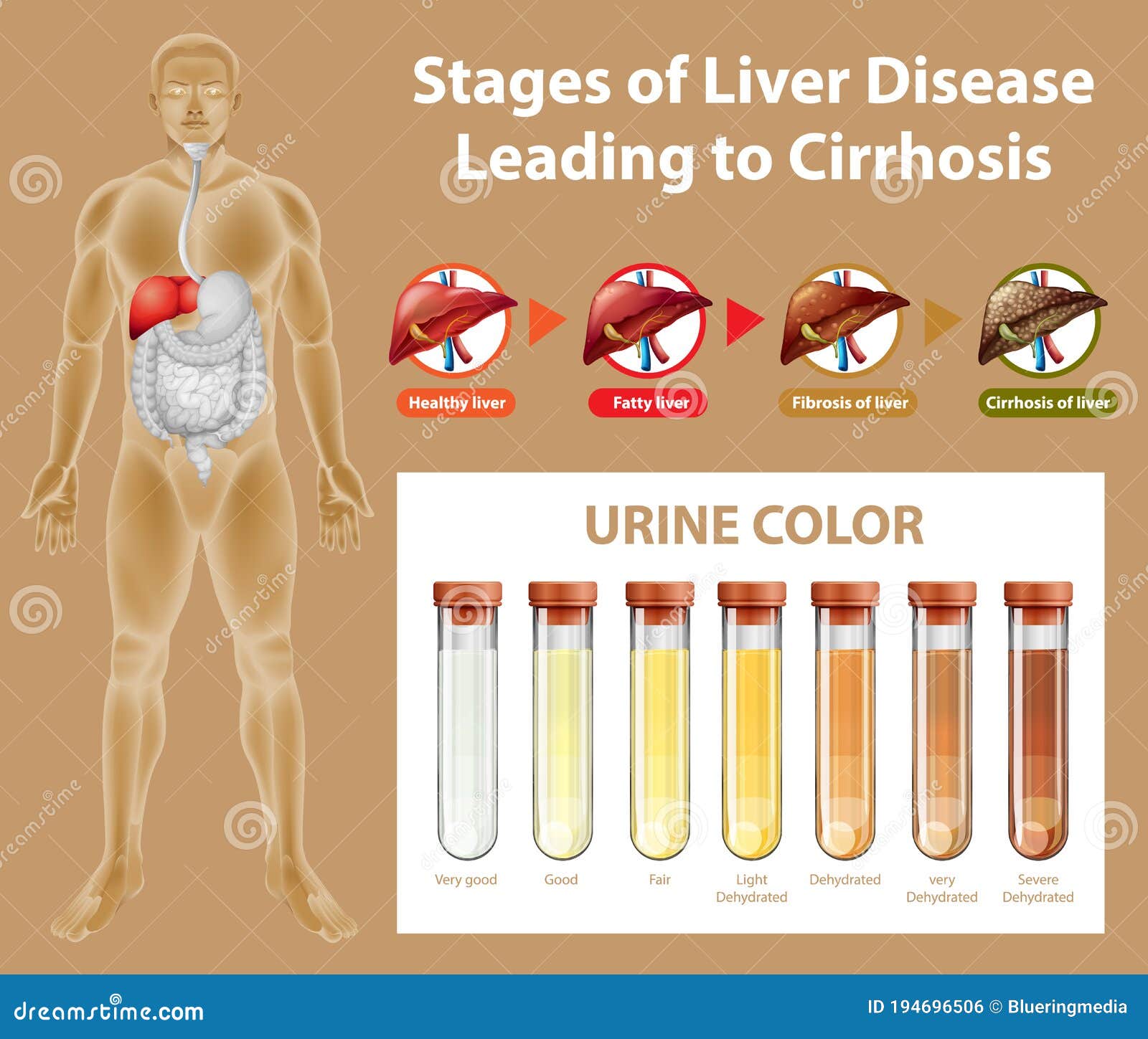 Liver Cirrhosis Stages