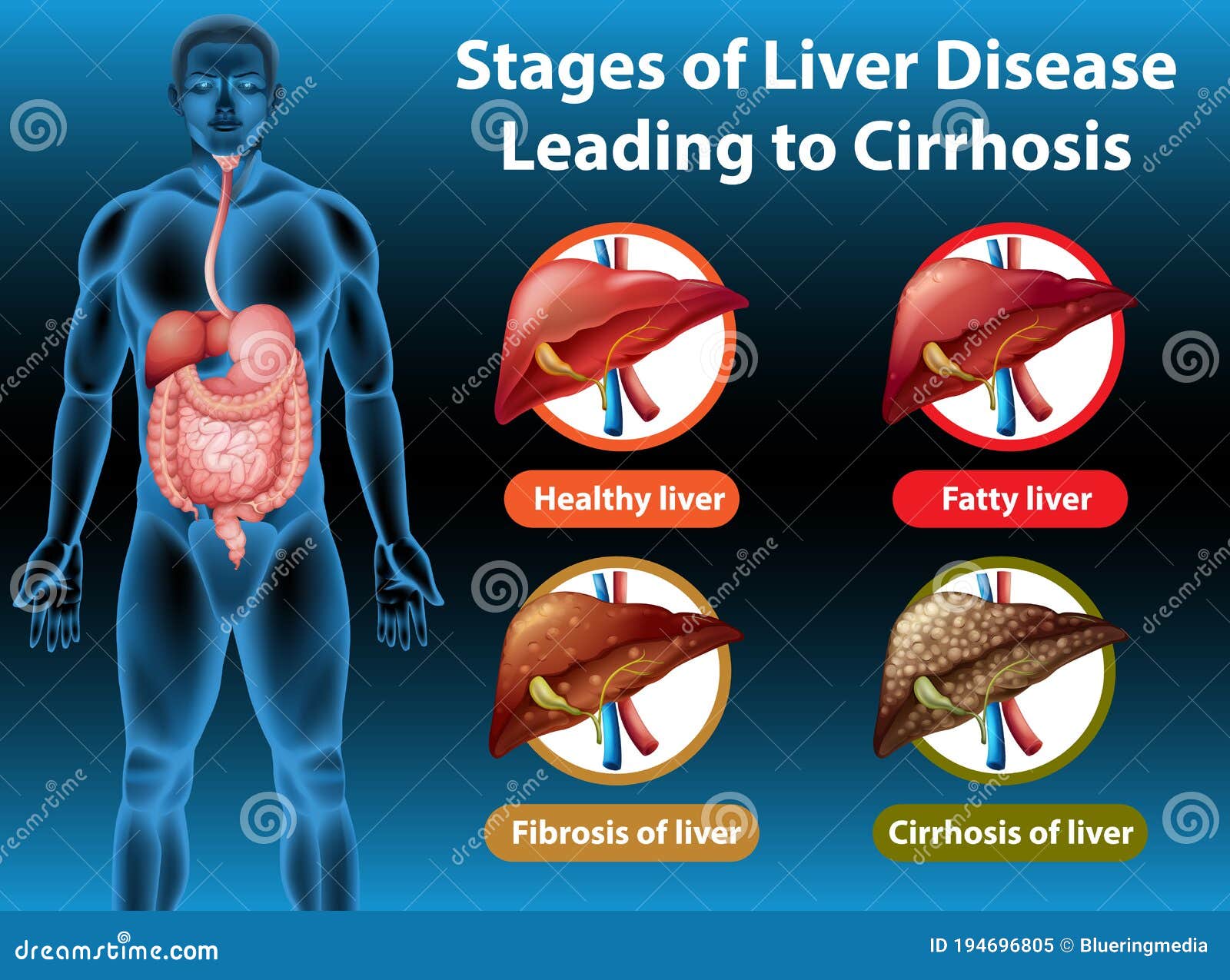 Liver Cirrhosis Final Stages