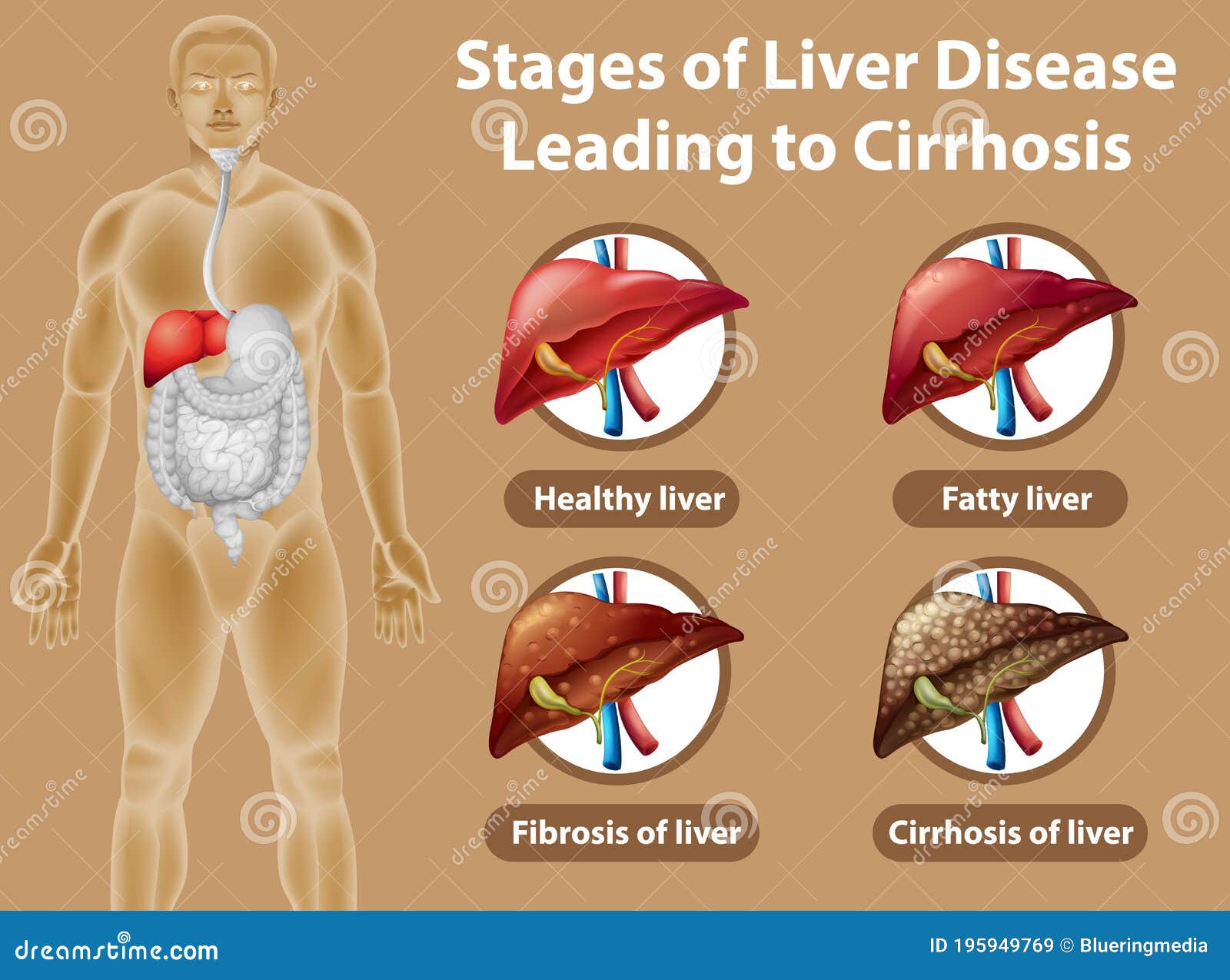 Stages Of Liver Disease Leading To Cirrhosis Stock Vector