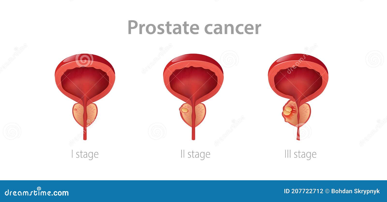 Are there different stages of prostate cancer Are there different stages of prostate cancer