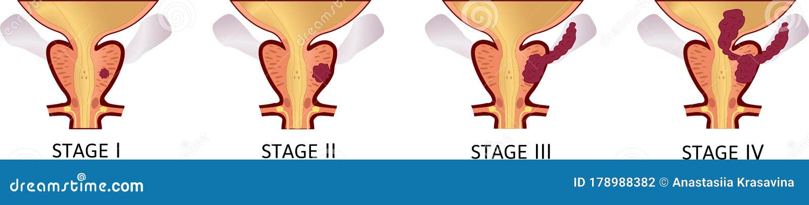 Stages prosztatitis. Hranic prostatitis hogyan lehet kezelni