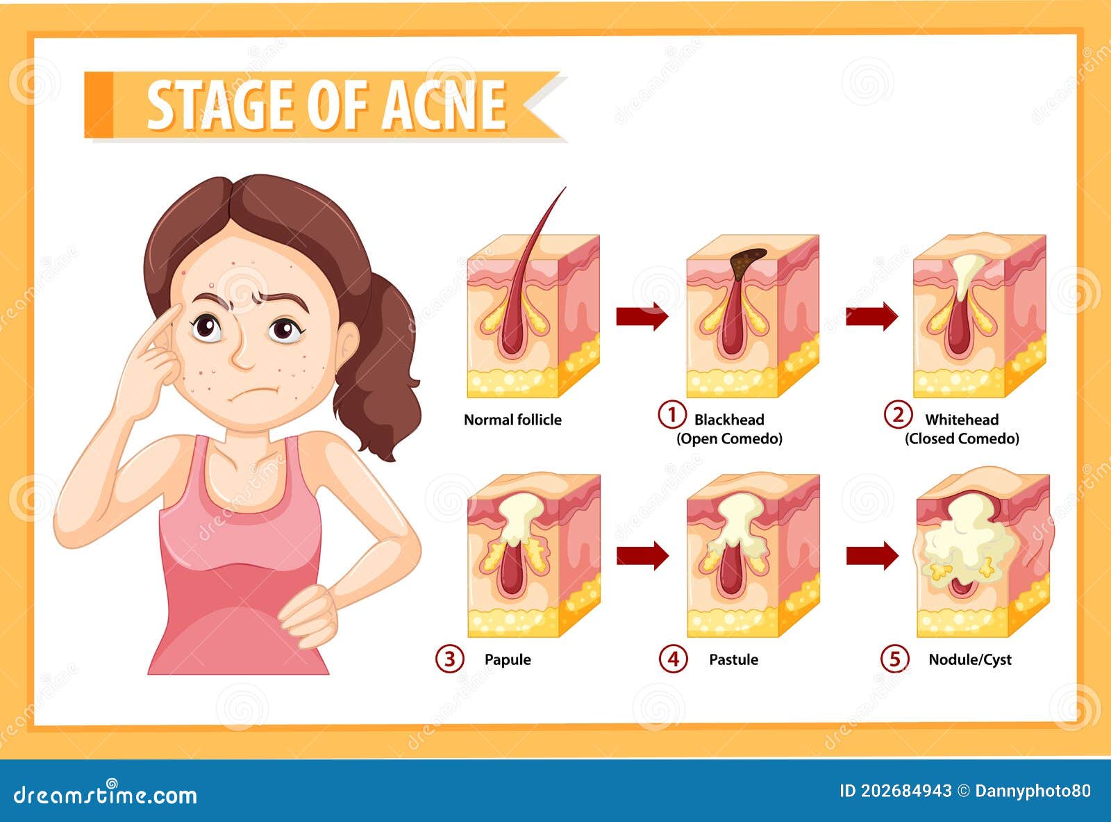 Stages Of Acne Formation In The Human Skin Cartoon Vector