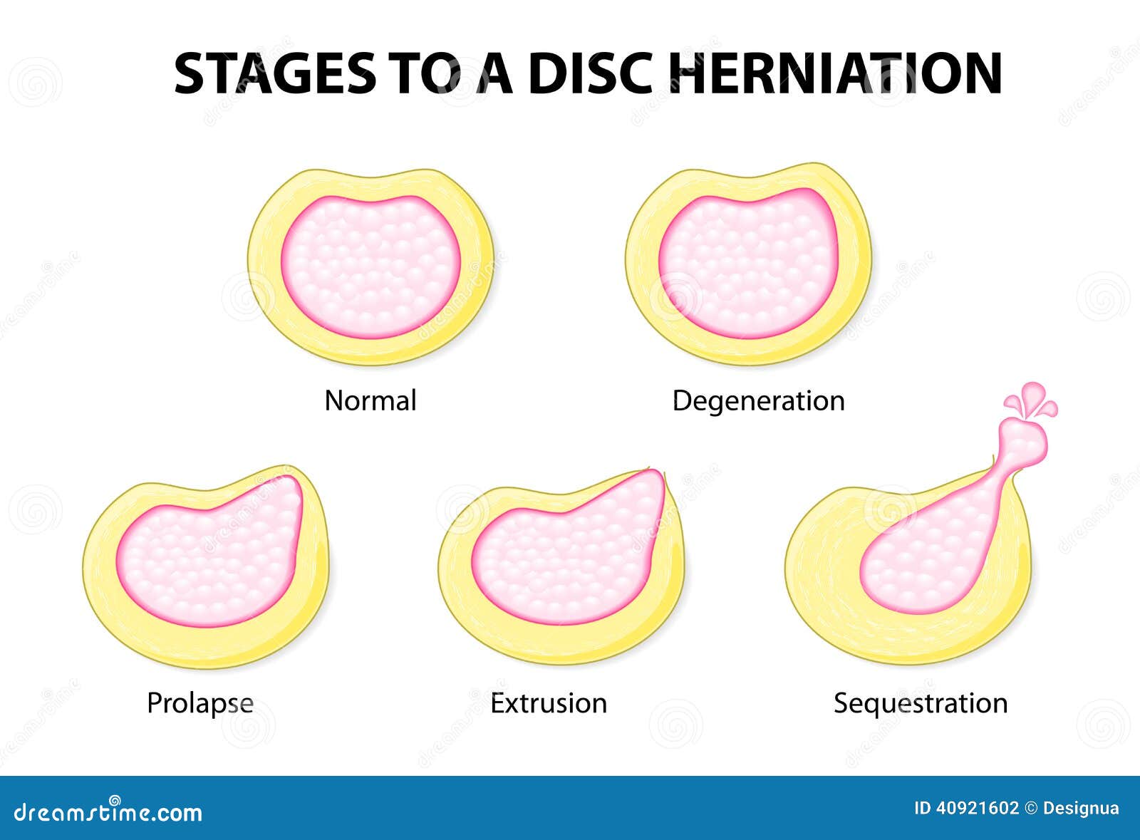 stages to a disc herniation
