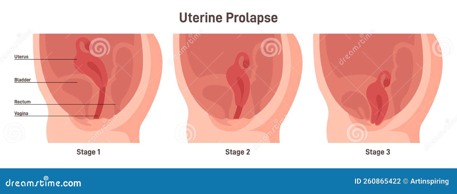 Stages of Uterine Prolapse. Pelvic Floor Muscles Weakening, Support Stock  Vector - Illustration of muscle, vagina: 260865422