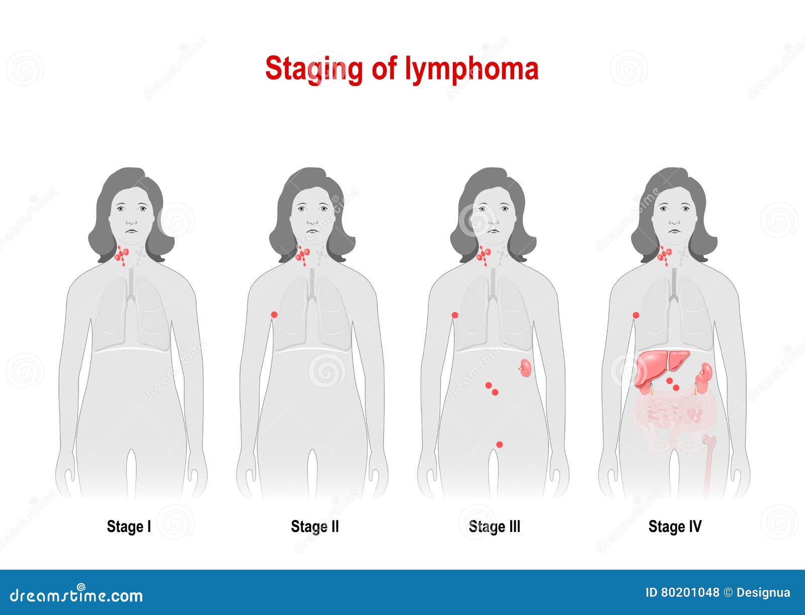 staging of lymphoma. woman silhouette with highlighted internal