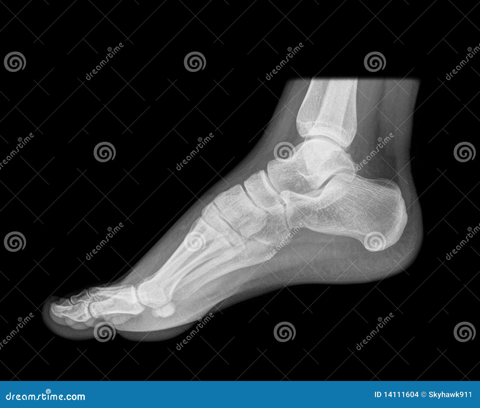 Standing foot on xray stock photo. Image of diagnosis 14111604
