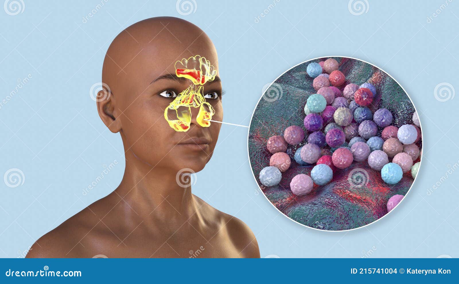 ESA - Staphylococcus aureus (MRSA) bacteria