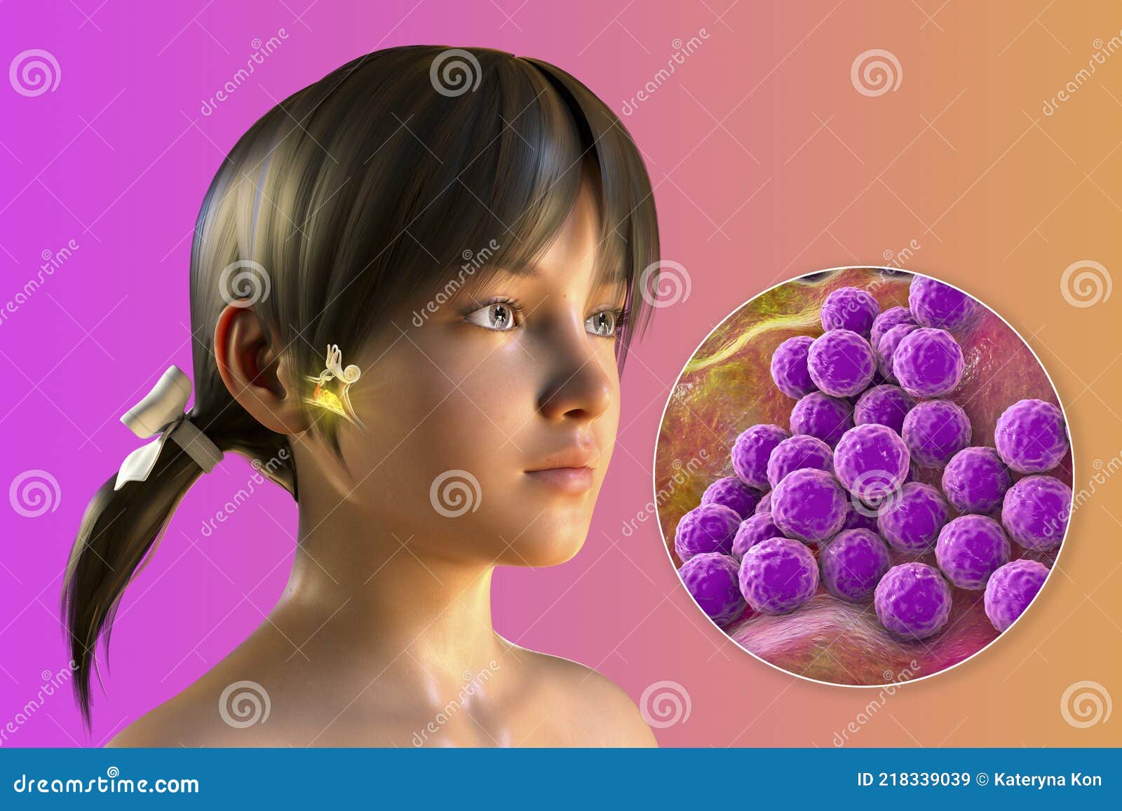 Staphylococcus Aureus Bacterium As A Cause Of Otitis Media Stock Illustration Illustration Of 