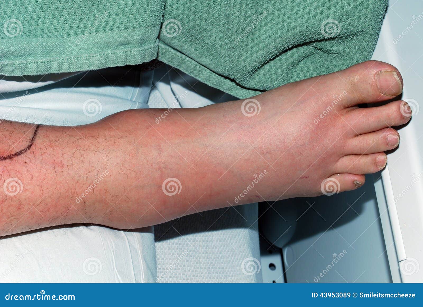 Staphylocoque Infecton image stock. Image du gonflé, malade - 43953089