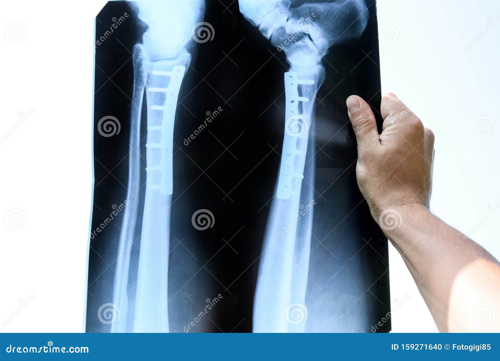 Steel Plate Holding Together the Tibia of the Leg Stock Photo Image