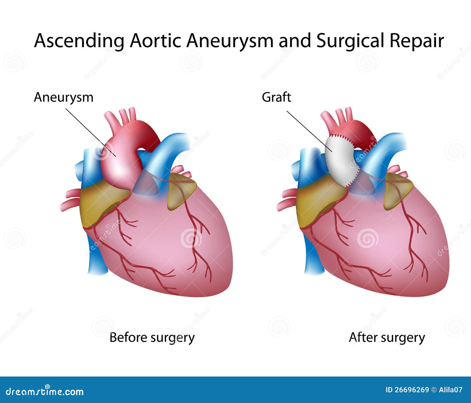 Steigender Aortenaneurysm vektor abbildung. Illustration von reparatur