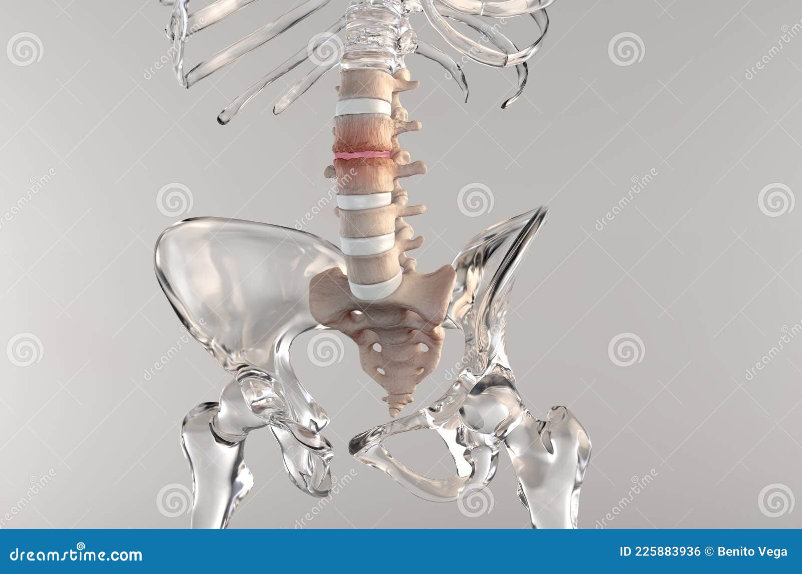 stenosis of the lumbar spine