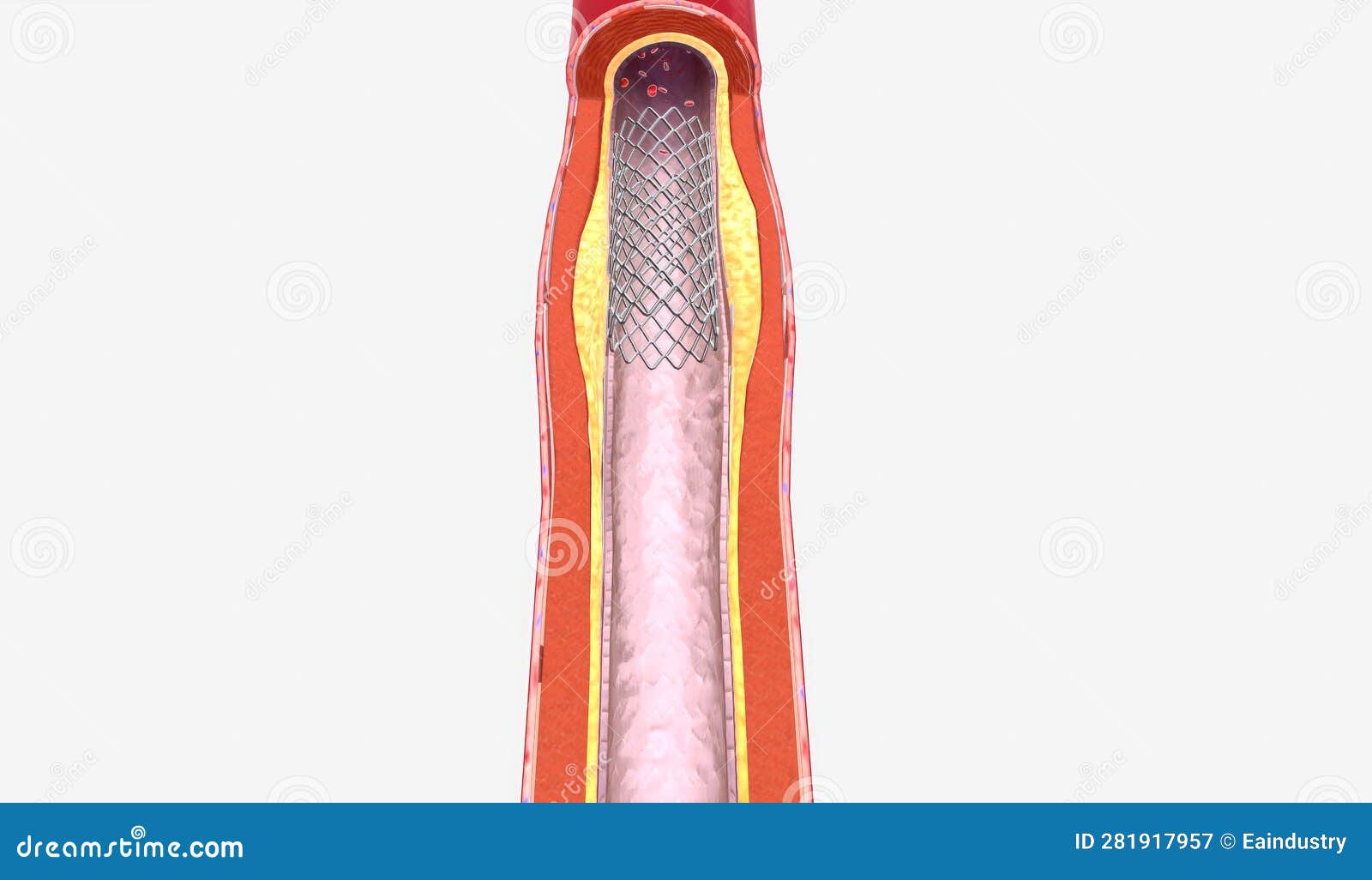 Stent Insertion into Artery Narrowed from Plaque Stock Illustration
