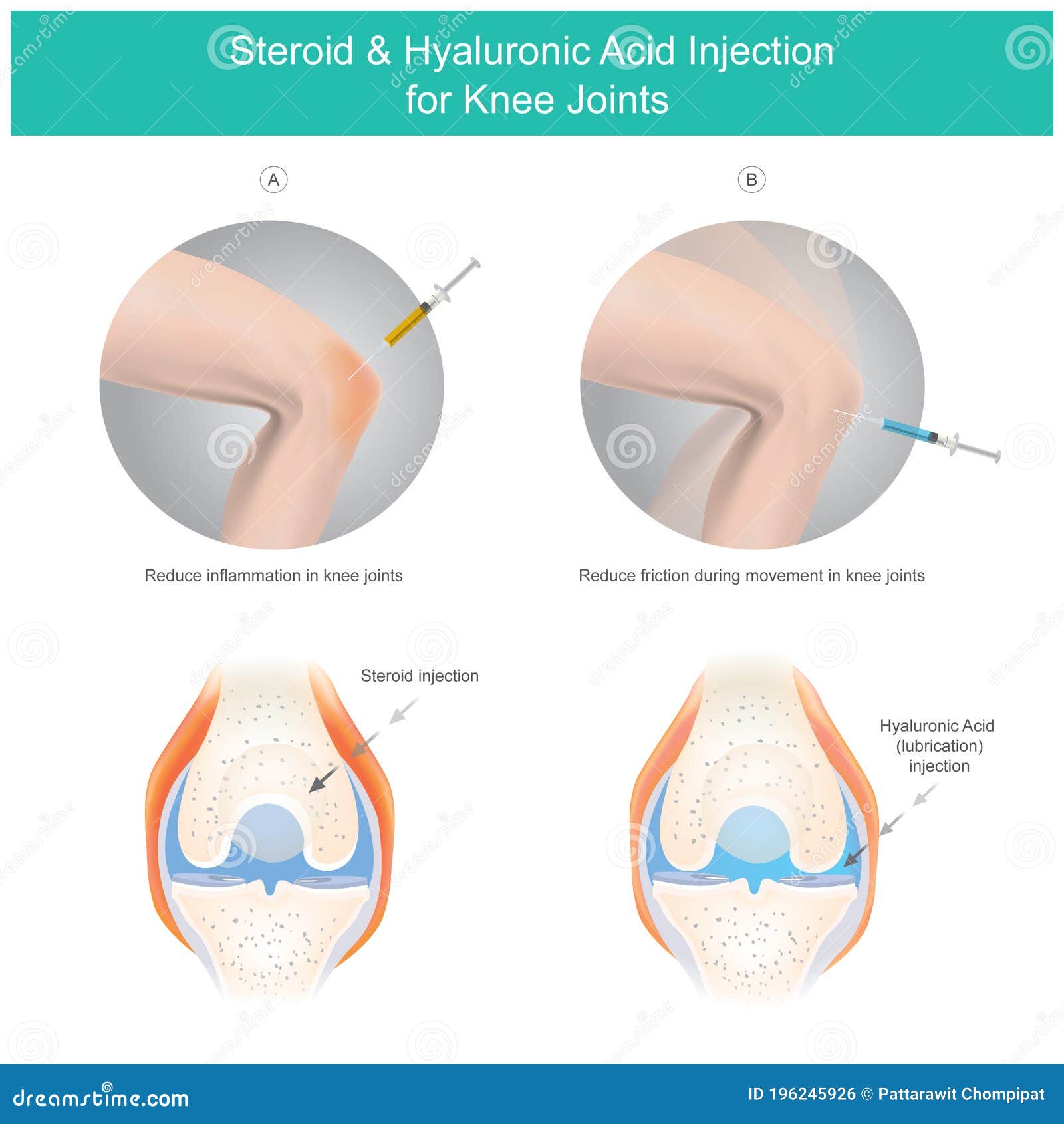 Knee Joints Royalty Free Stock Photography CartoonDealer 43014521 knee-joints-royalty-free-stock-photography-cartoondealer-43014521