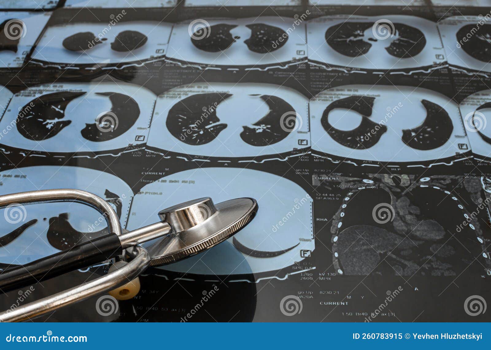 Stethoscope on the Background of Xrays of the Lungs Stock Image