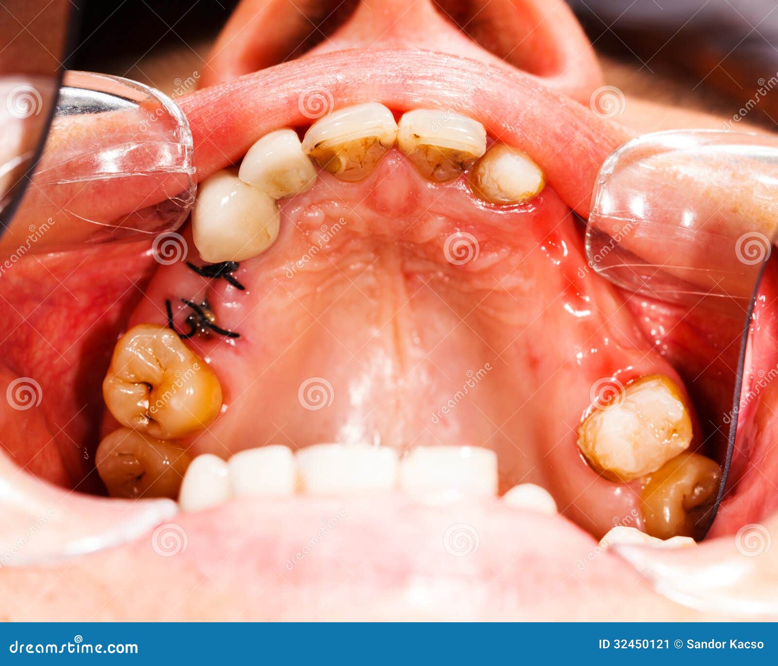 Why Do The Stitches In My Gums Hurt?