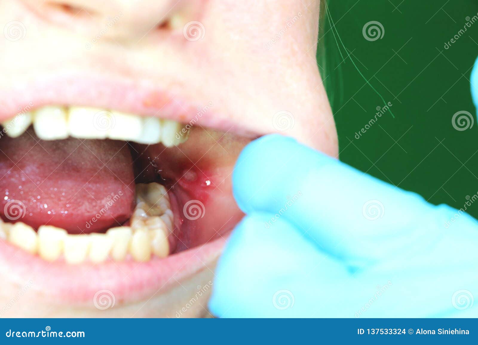 painful ulcer and stomatitis on the mucous cheek of a girl. after the operation to remove the wisdom teeth. stitches and