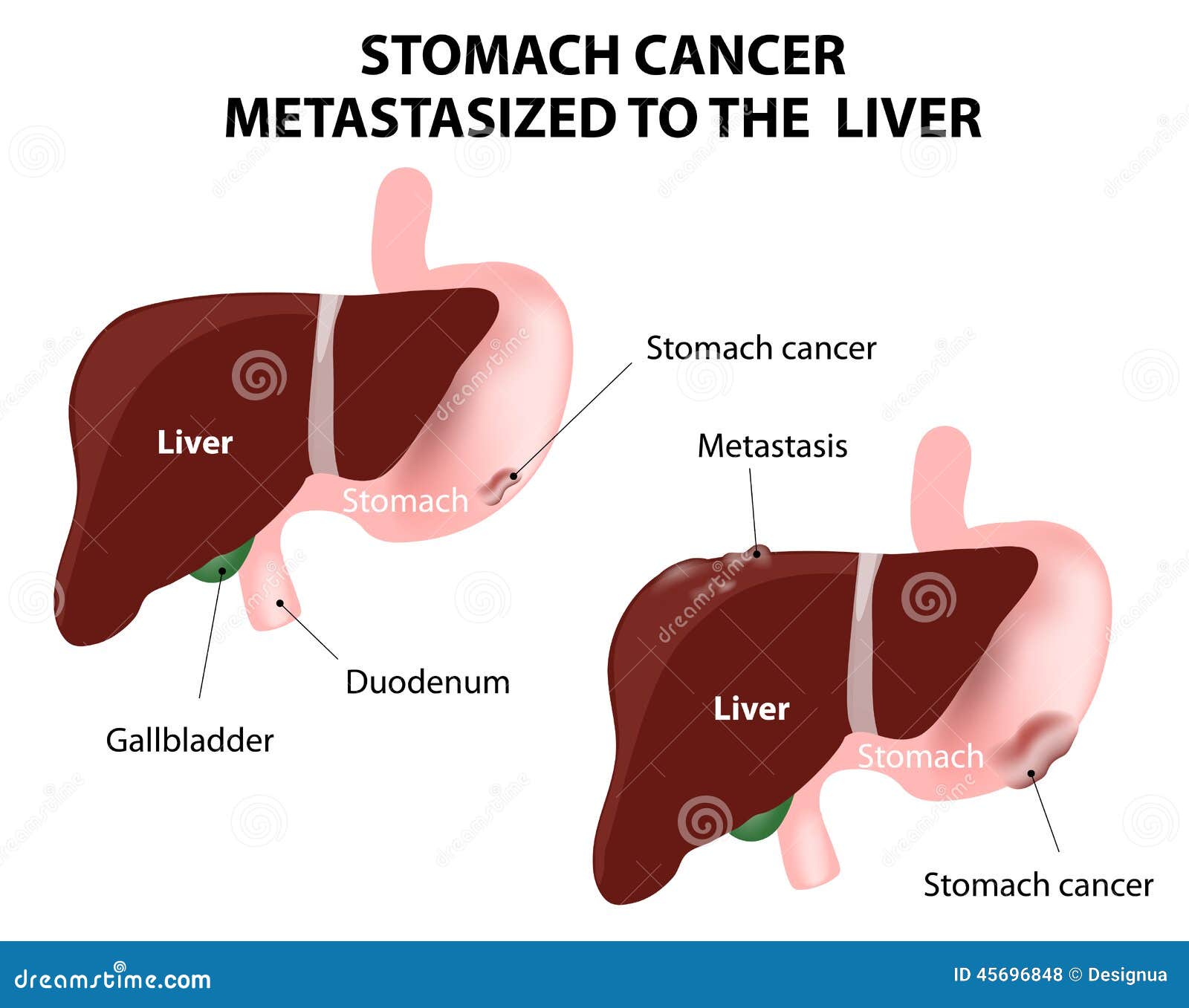 stomach cancer metastasized to the liver