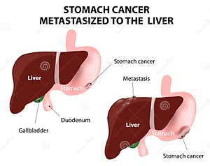 Stomach Cancer Operation Stock Photo CartoonDealer 53027580