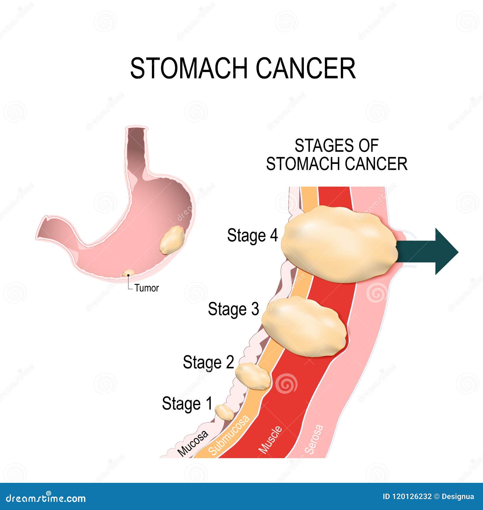 abdominal cancer tumours