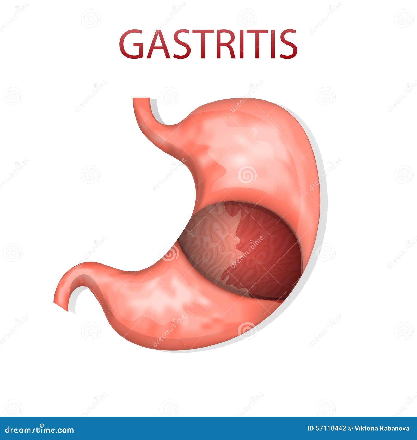 stomach, gastritis