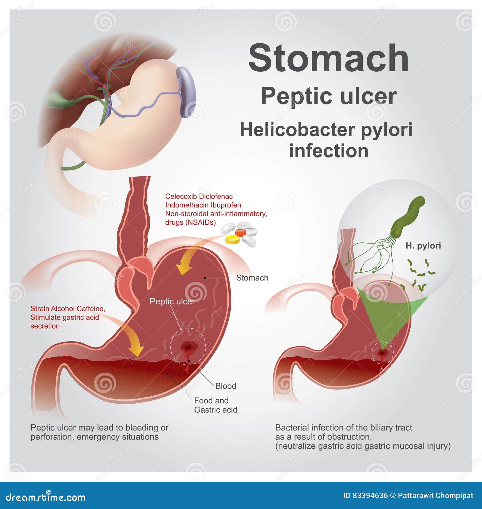 stomach peptic ulcer.