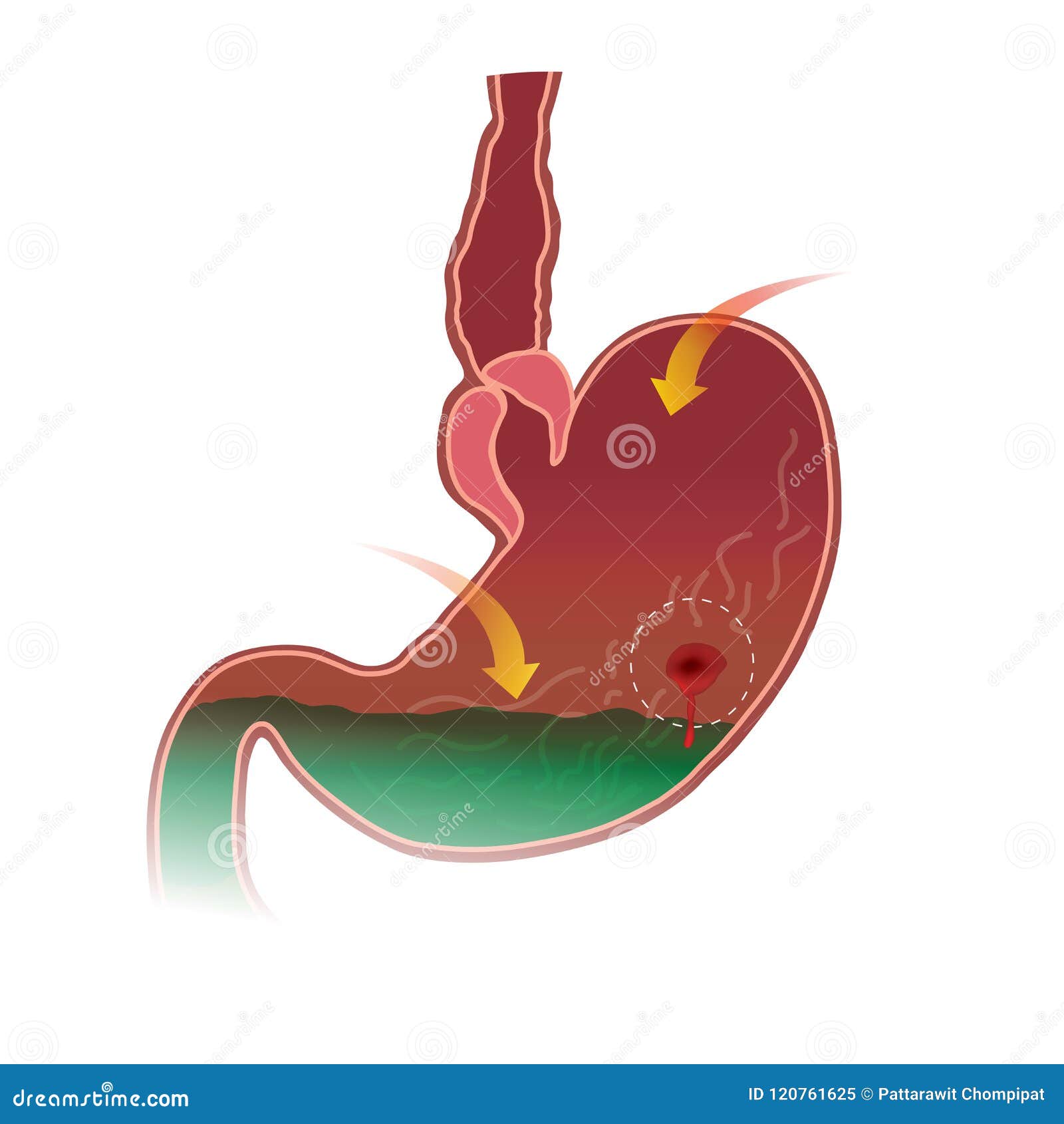 stomach peptic ulcer. white background isolate.