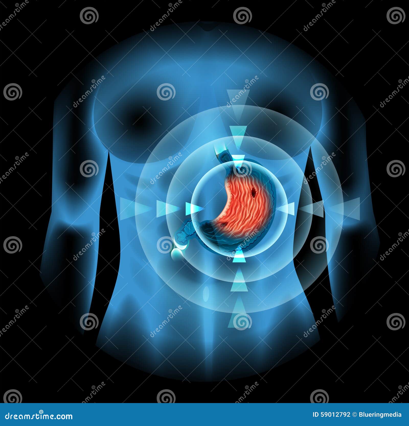 Stomach Ulcer Diagram In Woman Stock Vector