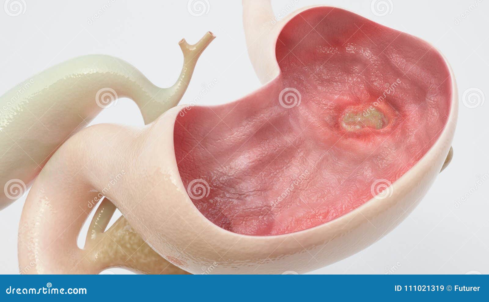 stomach ulcer - high degree of detail - 3d rendering