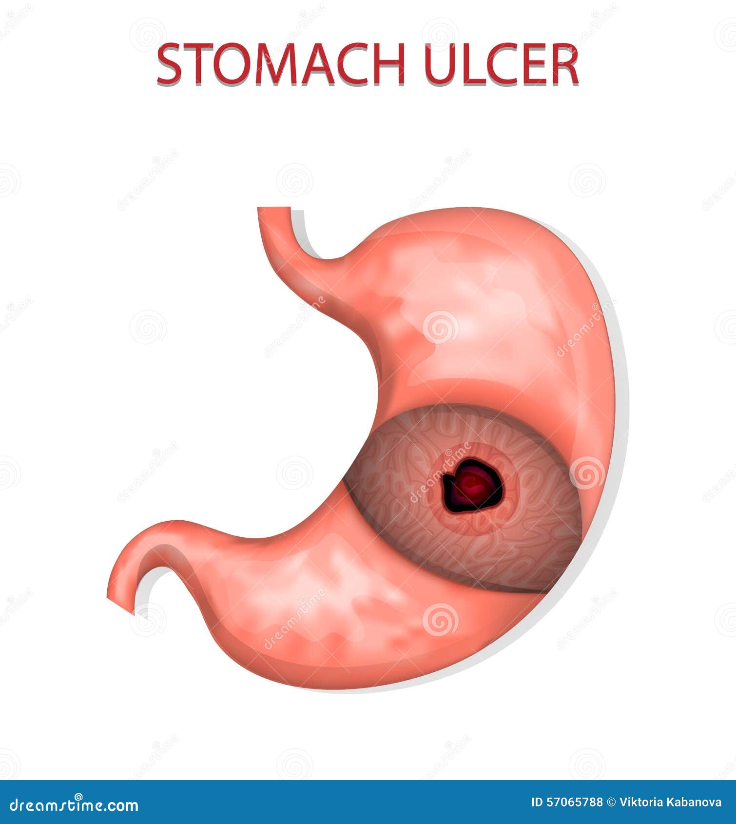 stomach ulcer