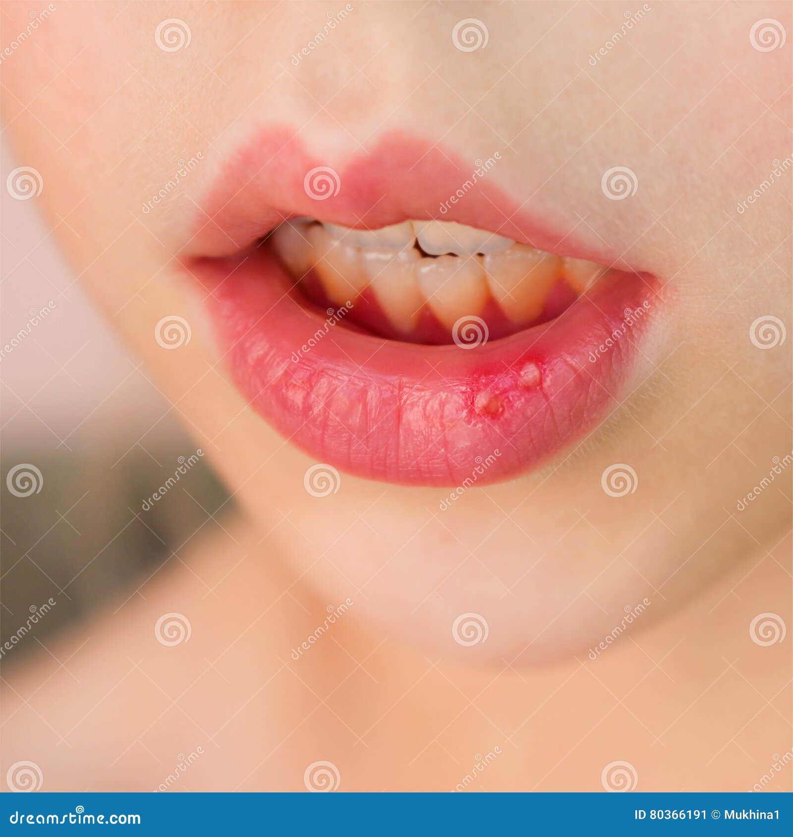 Stomatitis On Lip In Child Stock Image Image Of Childhood 80366191