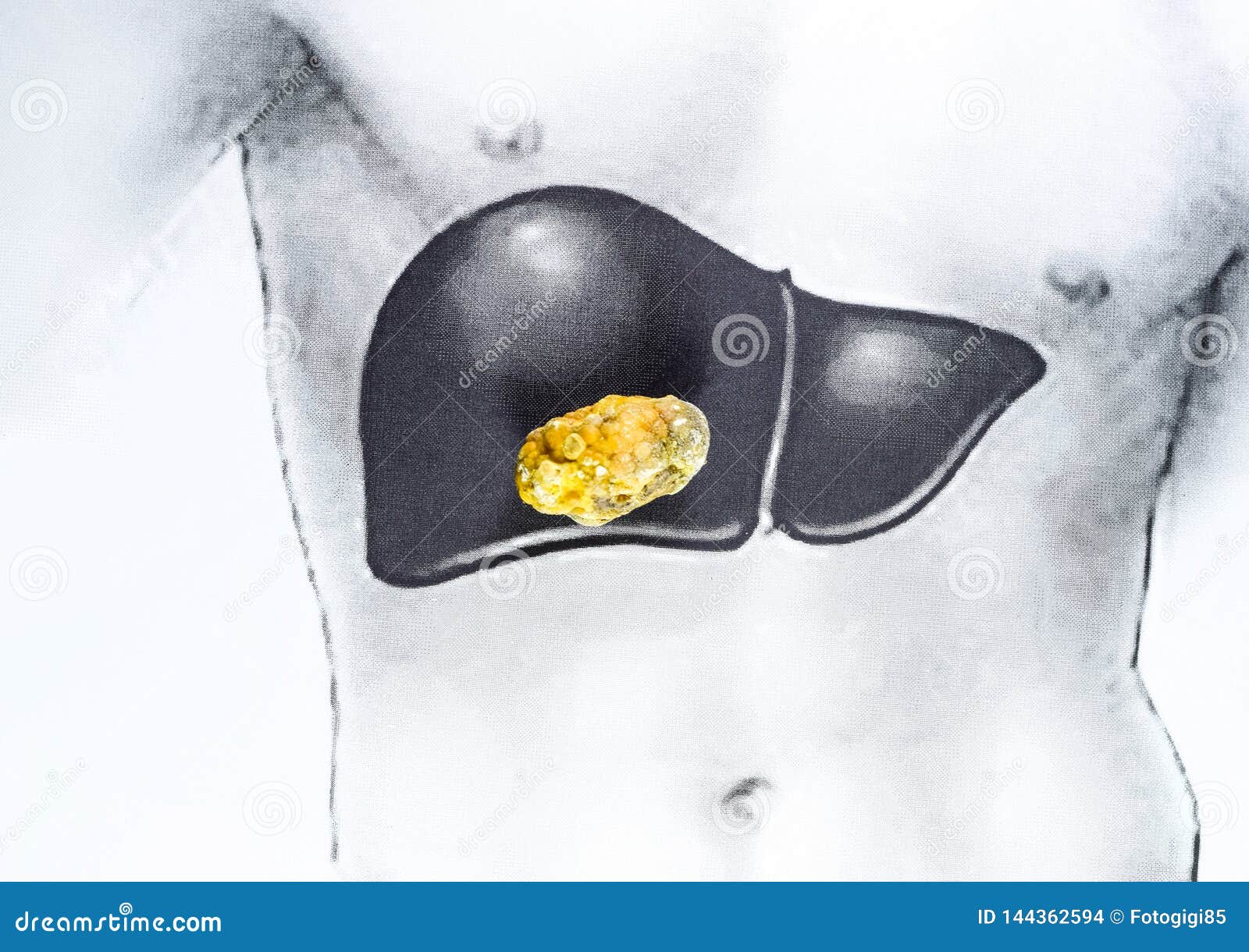 Stone in the Liver, Schematic Image, a Large Gallstone, the Result of